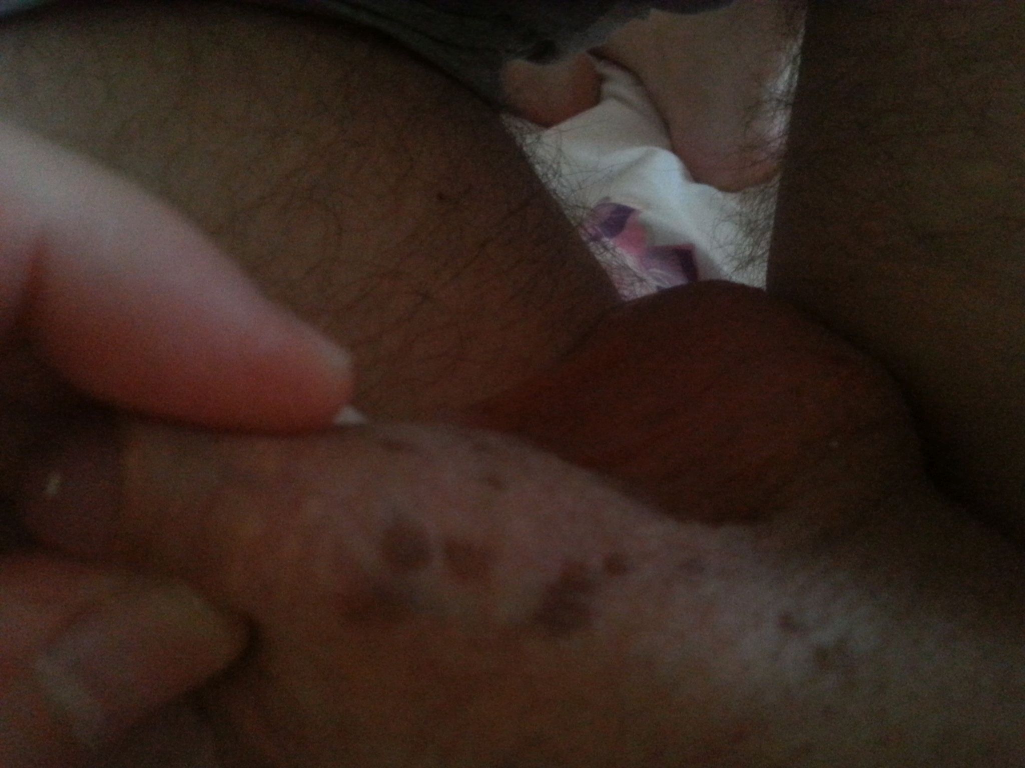 HPV Koterizayon, Yakma, Genital Siğil Ve Koter